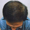 07.02. 2006 - efter 3 måneders kombineret behandling med Nutriol Shampoo and Hair Fitness og Galvanic Spa