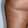 efter 8 uger med 2x2 ugentlige behandlinger med Galvnic Spa II og Body Shaping Gel