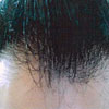 28.02. 2006 - efter tre måneders kombineret behandling med Nutriol Shampoo and Hair Fitness samt Galvanic Spa